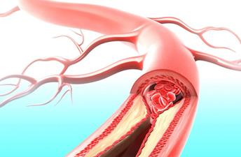 آترواسکلروز