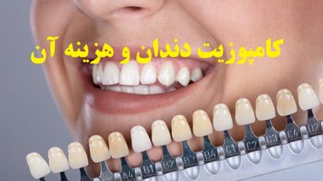 کامپوزیت دندان و هزینه آن