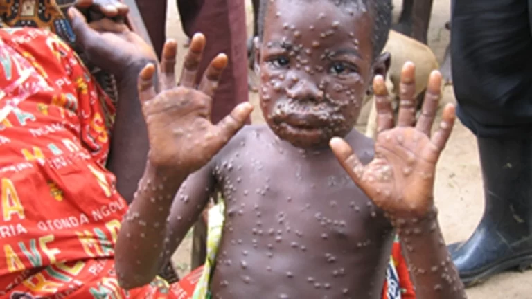 آبله میمونی