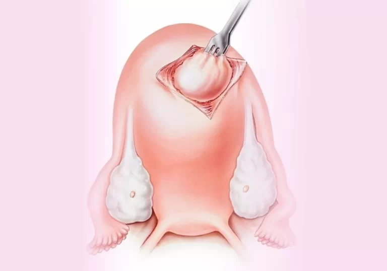 هزینه میومکتومی یا برداشتن فیبروم رحم در سال 1402