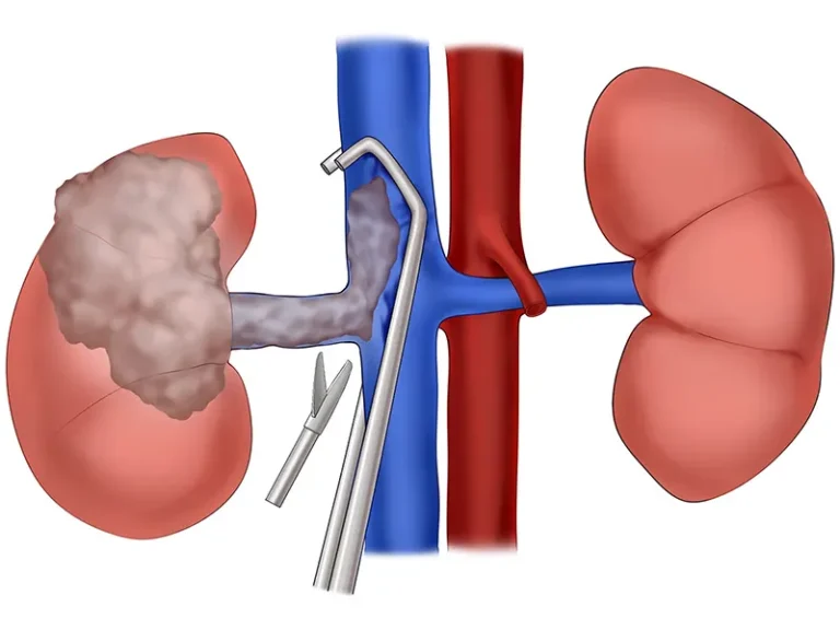 علت خونریزی بعد از عمل کلیه چیست؟